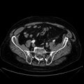 Abdominal aortic aneurysm (Radiopaedia 25855-26001 Axial C+ arterial phase 102).jpg