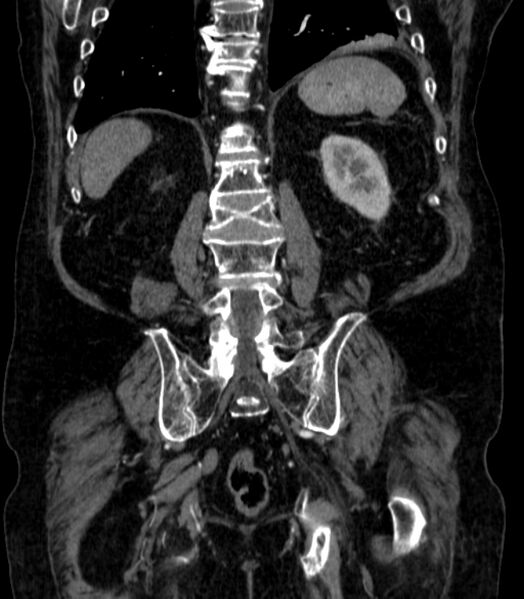 File:Abdominal aortic aneurysm (Radiopaedia 25855-26001 Coronal C+ arterial phase 58).jpg