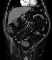 Abdominal aortic aneurysm (Radiopaedia 25855-26001 Coronal C+ arterial phase 9).jpg