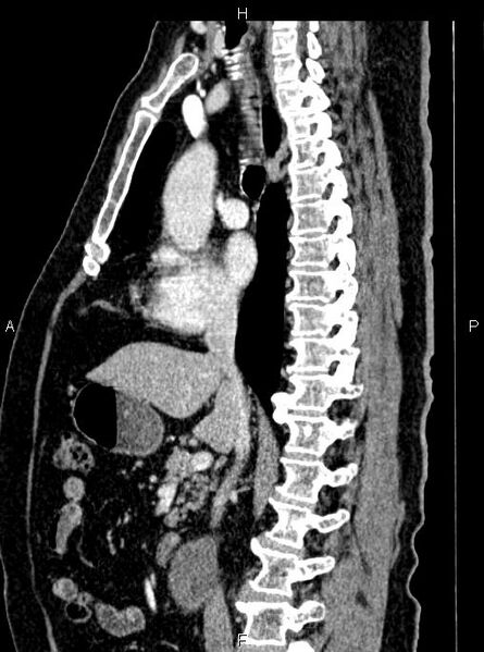 File:Abdominal aortic aneurysm (Radiopaedia 83094-97462 Sagittal renal cortical phase 59).jpg