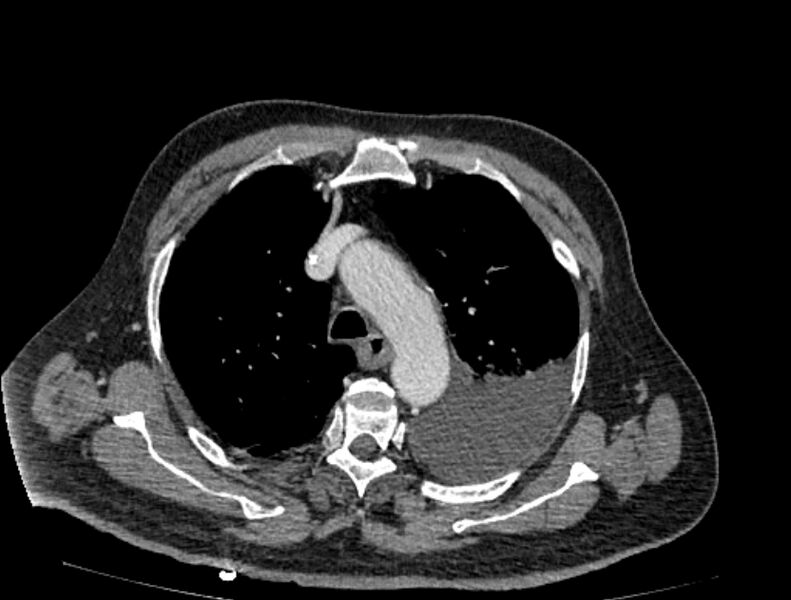 File:Abdominal aortic aneurysm rupture (Radiopaedia 54179-60362 Axial C+ portal venous phase 48).jpg