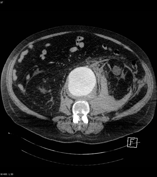 File:Abdominal aortic aneurysm with intramural hematoma then rupture (Radiopaedia 50278-55632 Axial C+ arterial phase 96).jpg