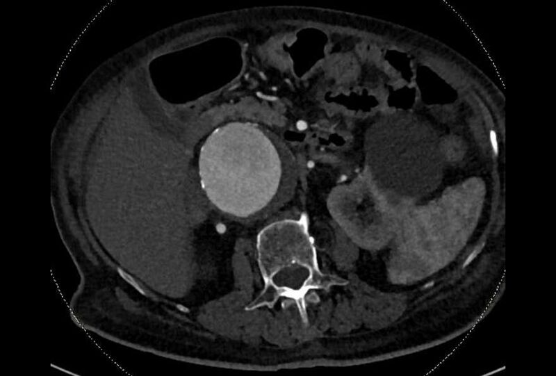 File:Abdominal aortic aneurysm with thrombus fissuration (Radiopaedia 73192-83919 Axial C+ arterial phase 59).jpg