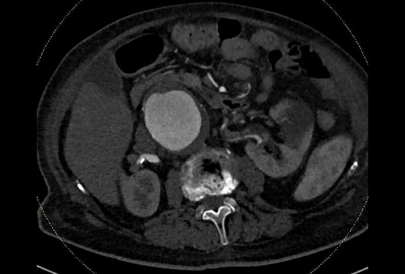 File:Abdominal aortic aneurysm with thrombus fissuration (Radiopaedia 73192-83919 Axial C+ arterial phase 67).jpg