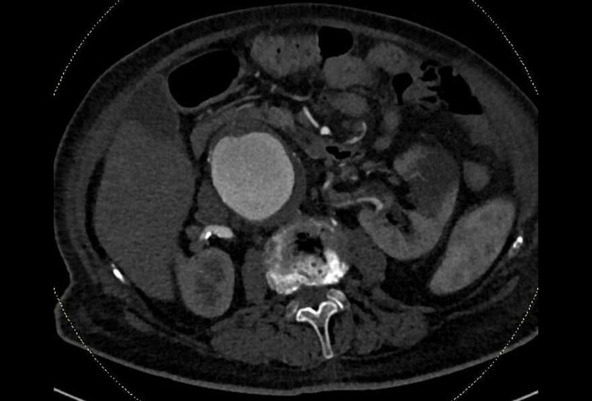 Abdominal aortic aneurysm with thrombus fissuration (Radiopaedia 73192-83919 Axial C+ arterial phase 67).jpg