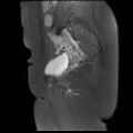 Abdominal wall endometriosis (Radiopaedia 83702-98847 Sagittal T1 C+ fat sat 5).jpg