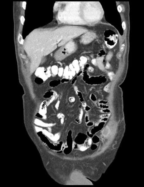 File:Abdominal wall metastasis from colorectal carcinoma (Radiopaedia 31016-31717 Coronal C+ portal venous phase 12).jpg