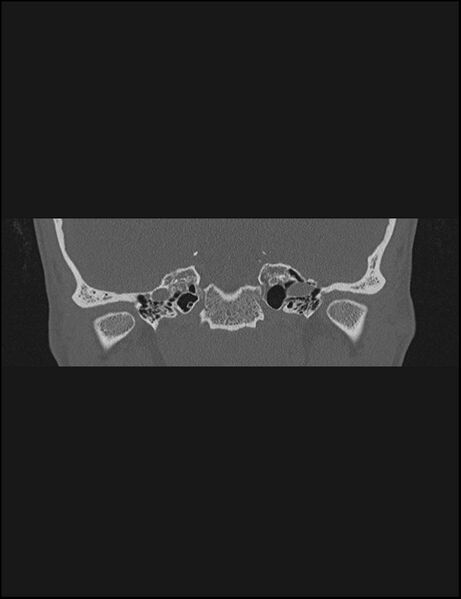 File:Aberrant right internal carotid artery (Radiopaedia 65191-74198 Coronal non-contrast 30).jpg