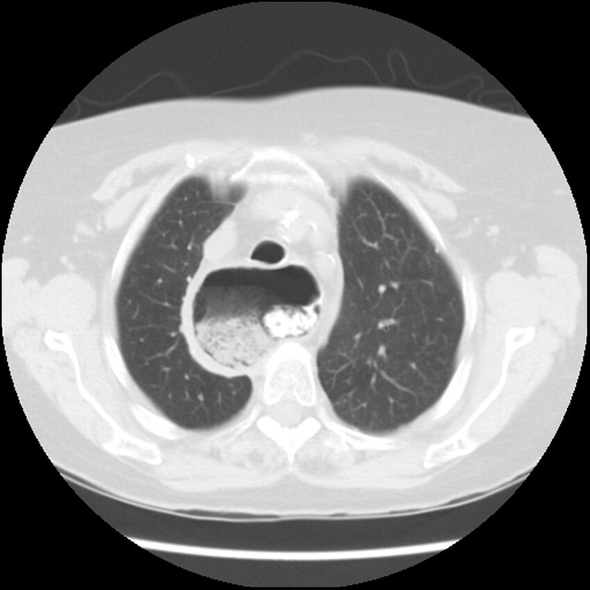 Achalasia (Radiopaedia 44094-47649 Axial lung window 13).jpg