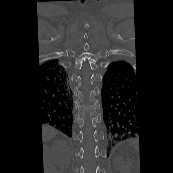 File:Acute and chronic vertebral compression fractures (Radiopaedia 31608-32494 Coronal bone window 35).jpg