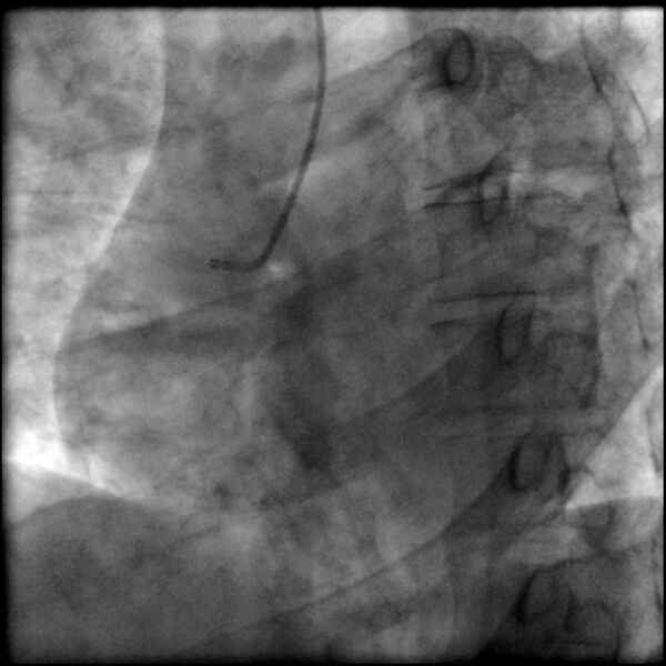File:Acute anteroseptal myocardial infarction (Radiopaedia 68409-77946 RAO straight RCA 5).jpg