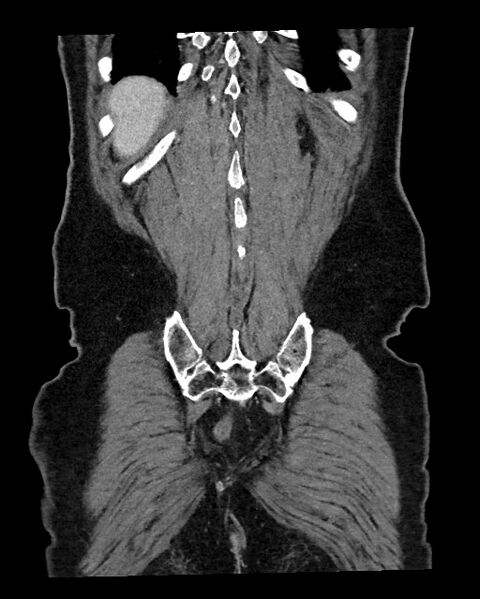 File:Acute appendicitis - large appendicoliths (Radiopaedia 61805-69820 Coronal C+ portal venous phase 117).jpg