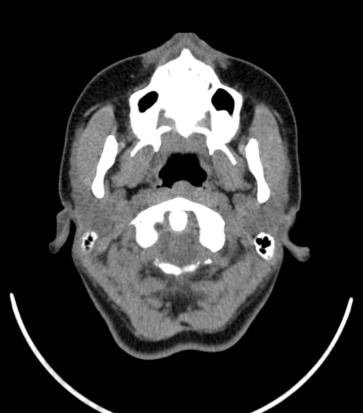 File:Acute bacterial tonsillitis (Radiopaedia 22882-22908 Axial non-contrast 9).png