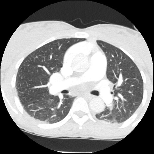 File:Acute chest syndrome - sickle cell disease (Radiopaedia 42375-45499 Axial lung window 86).jpg