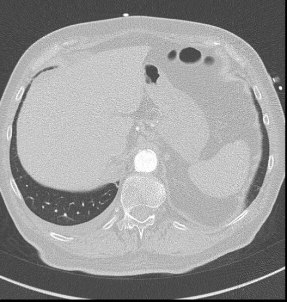 File:Acute myocardial infarction (Radiopaedia 23413-23481 lung window 68).jpg