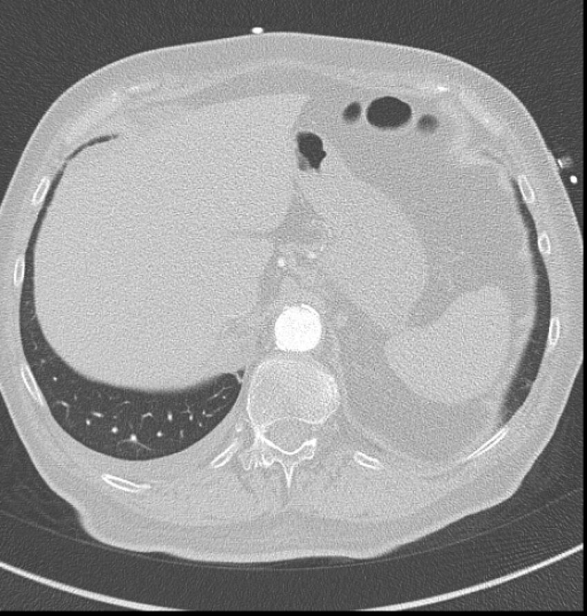 Acute myocardial infarction (Radiopaedia 23413-23481 lung window 68).jpg