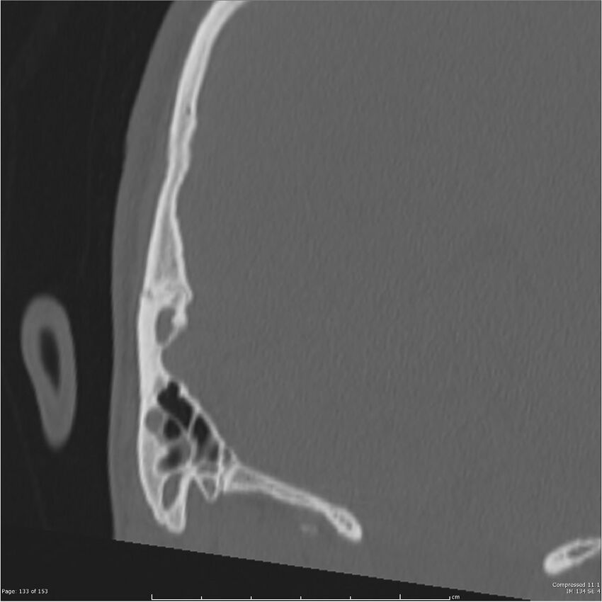 Acute otomastoiditis (Radiopaedia 28276-28512 Coronal PTB bone window reformat 64).jpg