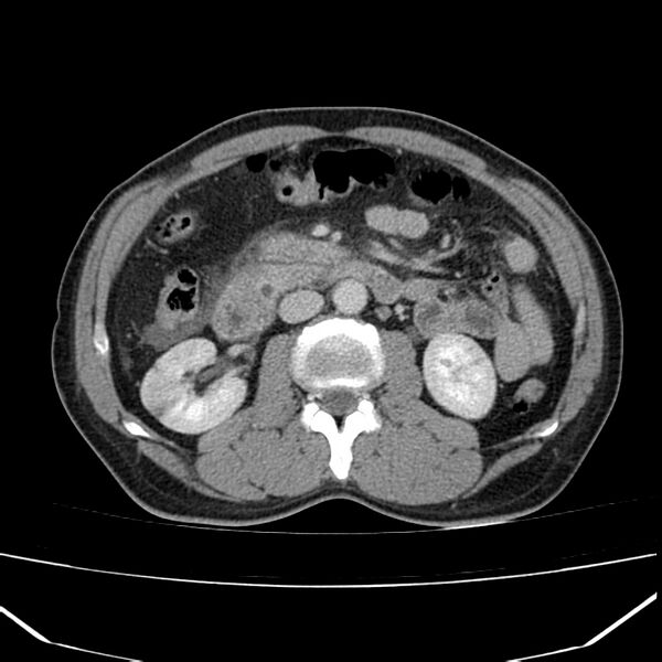 File:Acute pancreatitis (Radiopaedia 22572-22596 Axial C+ portal venous phase 33).jpg