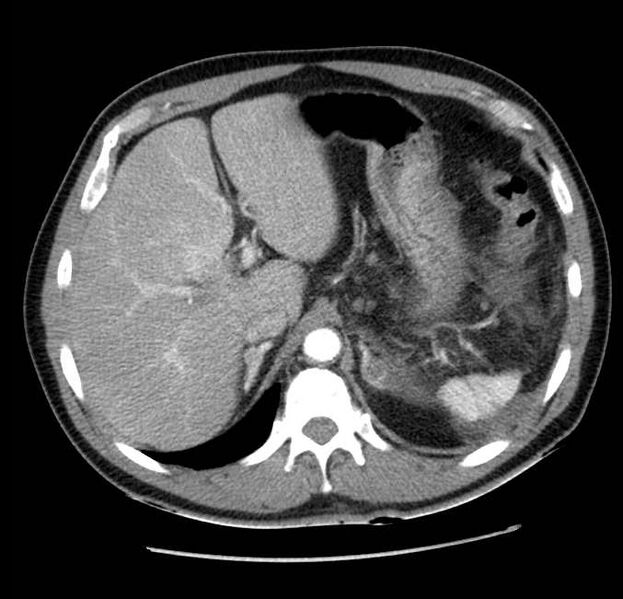 File:Acute pancreatitis - Balthazar E (Radiopaedia 23080-23110 Axial C+ arterial phase 16).jpg