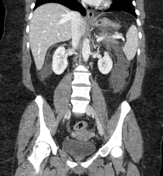 File:Acute pancreatitis - Balthazar E (Radiopaedia 29016-29377 Coronal C+ portal venous phase 55).png