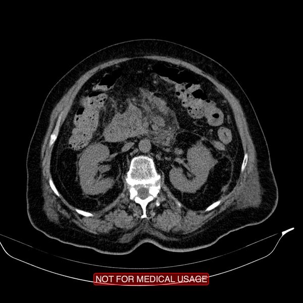 File:Acute pancreatitis with infected necrosis (Radiopaedia 26454-26585 Axial non-contrast 14).jpg