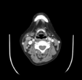 Acute parotitis (Radiopaedia 27425-27619 Axial C+ portal venous phase 39).png