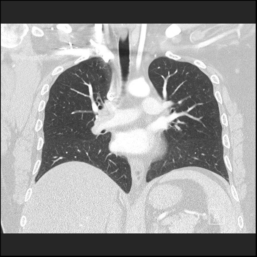 Acute pulmonary embolism with pulmonary infarct (Radiopaedia 73062-83768 Coronal lung window 41).jpg