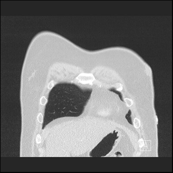 File:Acute pulmonary embolism with pulmonary infarct (Radiopaedia 73062-83768 Coronal lung window 7).jpg