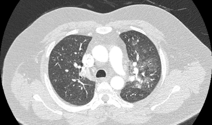 Acute pulmonary embolism with pulmonary infarcts (Radiopaedia 77688-89908 Axial lung window 35).jpg