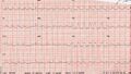Acute reversible pulmonary hypertension and right heart failure from cocaine toxicity (Radiopaedia 49394-54587 ECG 1).JPG