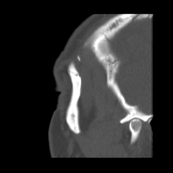 File:Acute sinusitis (Radiopaedia 23161-23215 Sagittal bone window 7).jpg