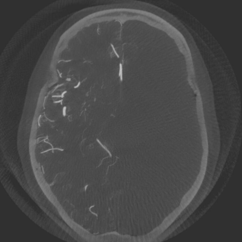 Acute subarachnoid hemorrhage and accessory anterior cerebral artery (Radiopaedia 69231-79010 Axial arterial - MIP 38).jpg