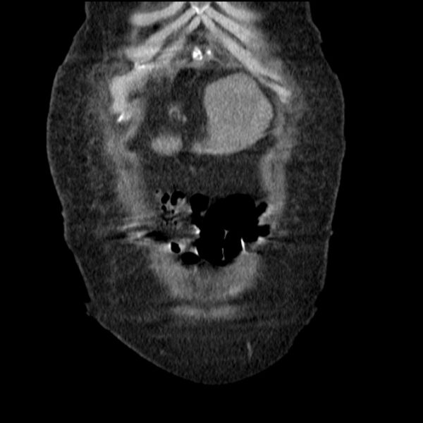 File:Acute tubular necrosis (Radiopaedia 28077-28334 D 15).jpg