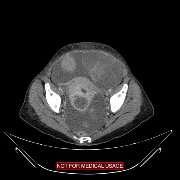 File:Adenocarcinoma of the cervix (Radiopaedia 28373-28616 Axial C+ portal venous phase 19).jpg