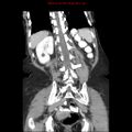 Adenocarcinoma of the colon (Radiopaedia 8191-9039 Coronal liver window 36).jpg