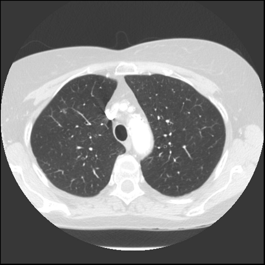 Adenocarcinoma of the lung (Radiopaedia 41015-43755 Axial lung window 32).jpg