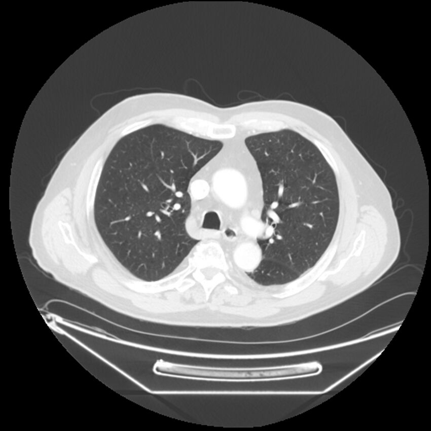 Adenocarcinoma of the lung (Radiopaedia 44876-48759 Axial lung window 28).jpg
