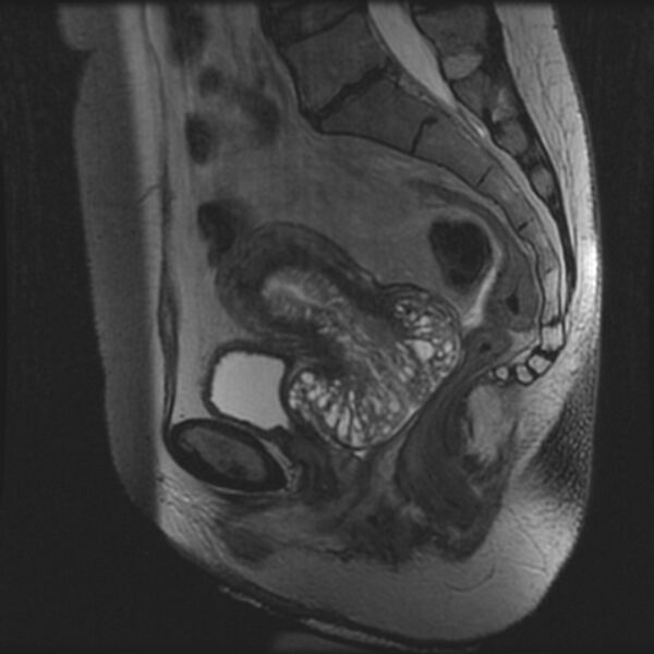 File:Adenoma malignum of the cervix (Radiopaedia 24460-24765 T2 57).jpg