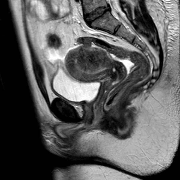 File:Adenomyoma of the uterus (Radiopaedia 9871-10439 Sagittal T2 14).jpg