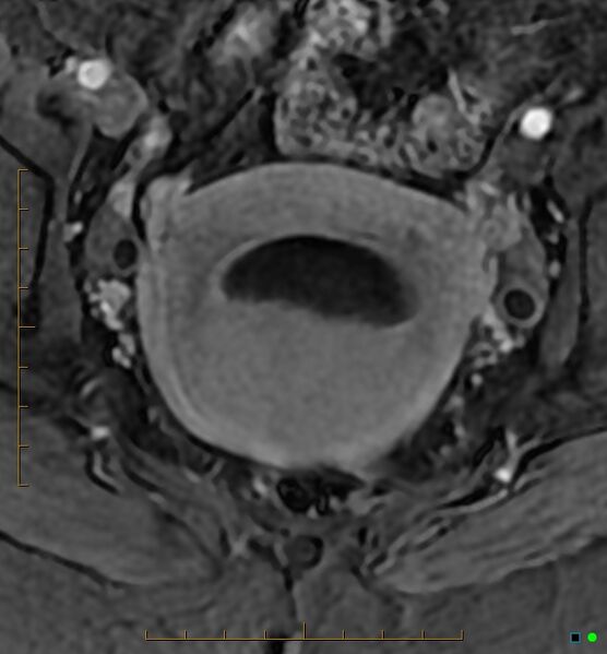 File:Adenomyosis uterus with hematometra (Radiopaedia 45779-50011 Axial T1 C+ fat sat 34).jpg