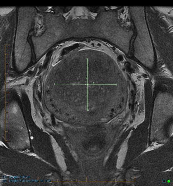 File:Adenomyosis uterus with hematometra (Radiopaedia 45779-50011 Coronal T2 14).jpg