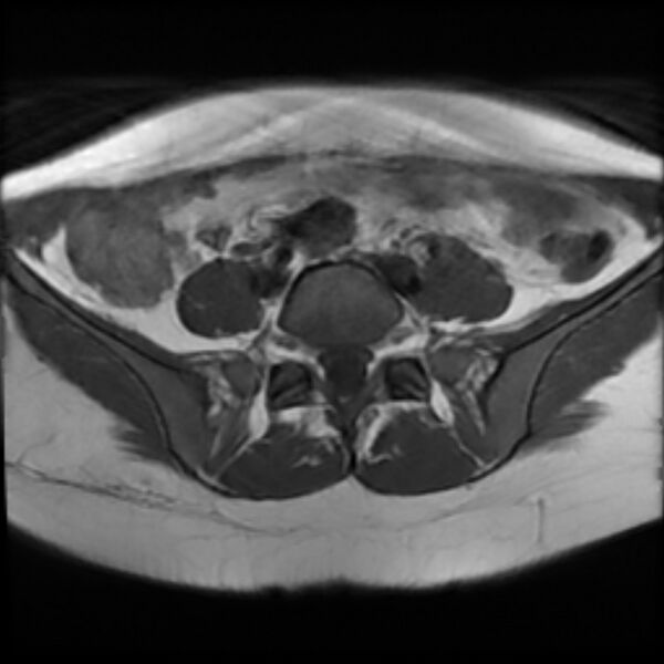 File:Adenomyosis within a septate uterus (Radiopaedia 69963-79981 Axial T1 4).jpg