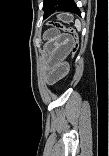 File:Adhesional small bowel obstruction (Radiopaedia 58900-66131 Sagittal C+ portal venous phase 221).jpg