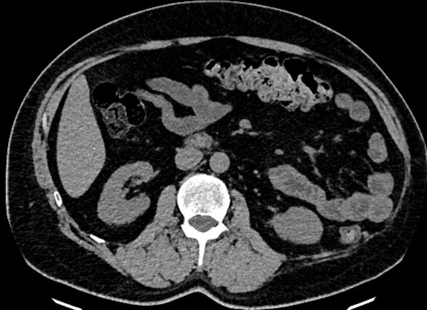 Adrenal metastases (Radiopaedia 73082-83791 Axial non-contrast 86).jpg