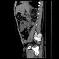 Adrenal myelolipoma (Radiopaedia 41843-44834 Sagittal non-contrast 17).jpg