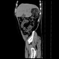 Adrenal myelolipoma (Radiopaedia 41843-44834 Sagittal non-contrast 3).jpg
