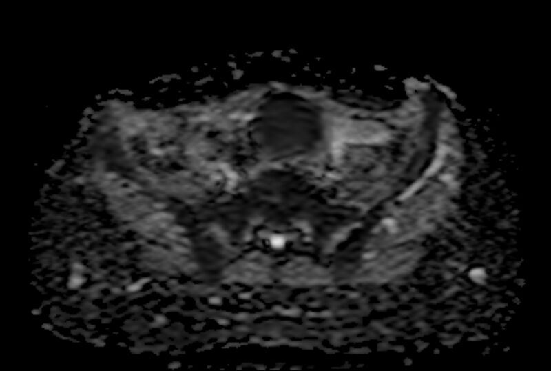 File:Adult granulosa cell tumor of the ovary (Radiopaedia 71581-81950 Axial ADC 8).jpg
