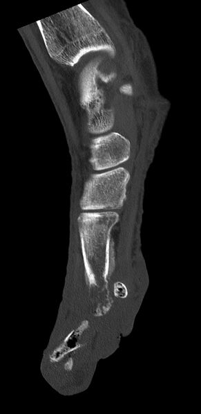 File:Advanced osteomyelitis due to open metatarsal fracture (Radiopaedia 83891-99095 C 5).jpg