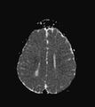 Aicardi syndrome (Radiopaedia 66029-75205 Axial ADC 16).jpg