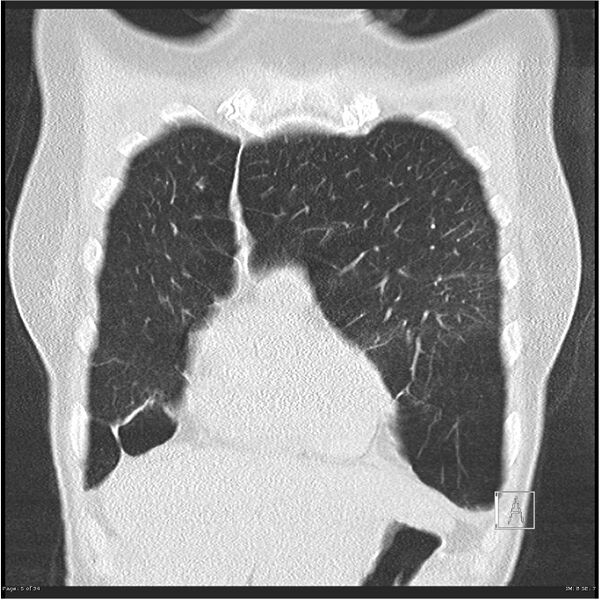 File:Alpha-1-antitrypsin deficiency (Radiopaedia 26537-26678 Coronal lung window 5).jpg